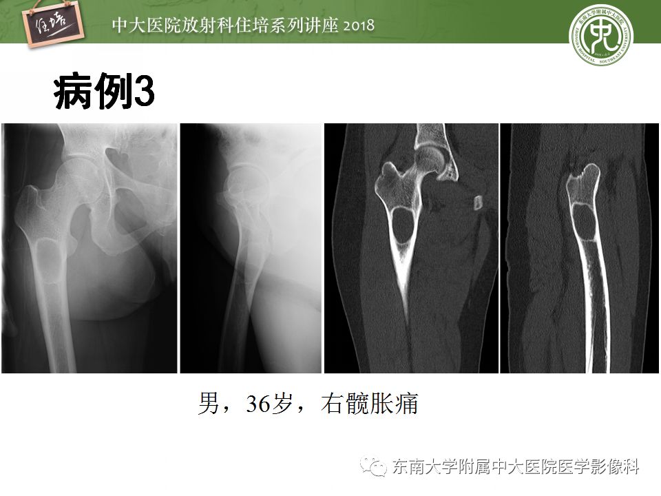 【PPT】骨肿瘤及类肿瘤病变的影像诊断思路