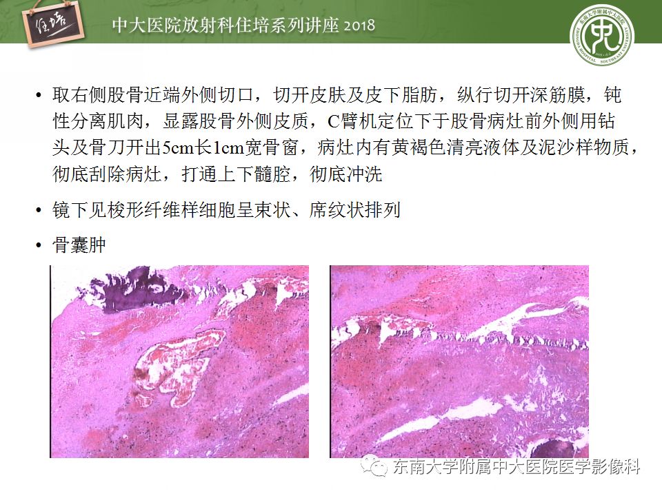 【PPT】骨肿瘤及类肿瘤病变的影像诊断思路