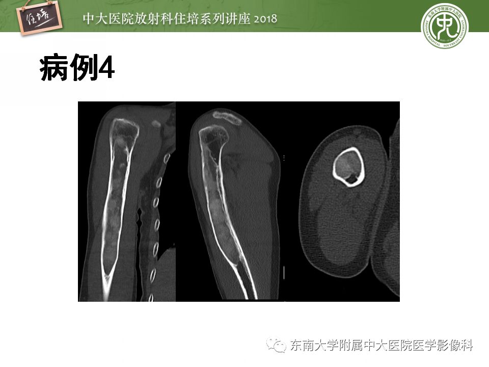 【PPT】骨肿瘤及类肿瘤病变的影像诊断思路