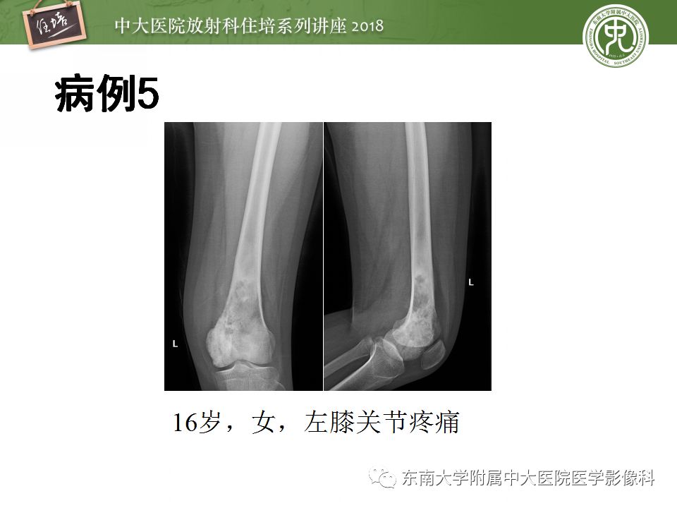【PPT】骨肿瘤及类肿瘤病变的影像诊断思路