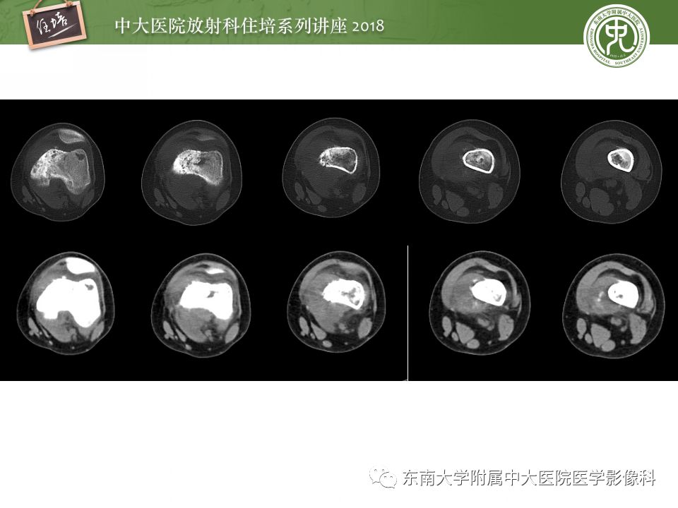 【PPT】骨肿瘤及类肿瘤病变的影像诊断思路