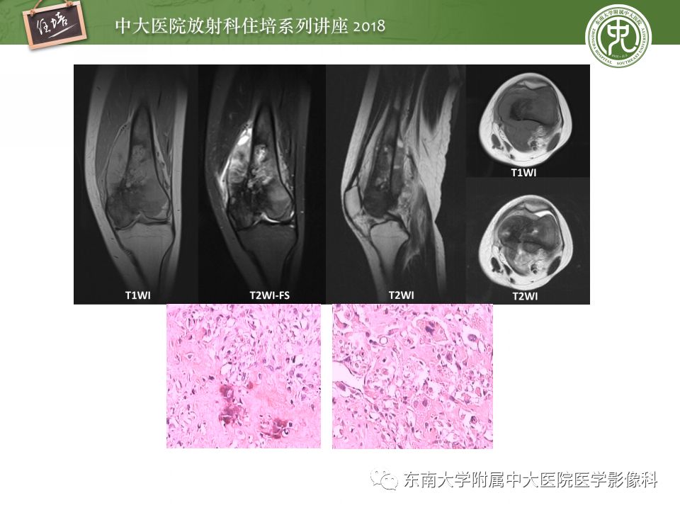 【PPT】骨肿瘤及类肿瘤病变的影像诊断思路