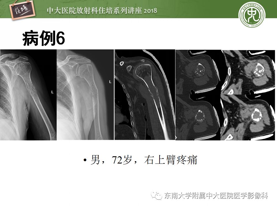 【PPT】骨肿瘤及类肿瘤病变的影像诊断思路