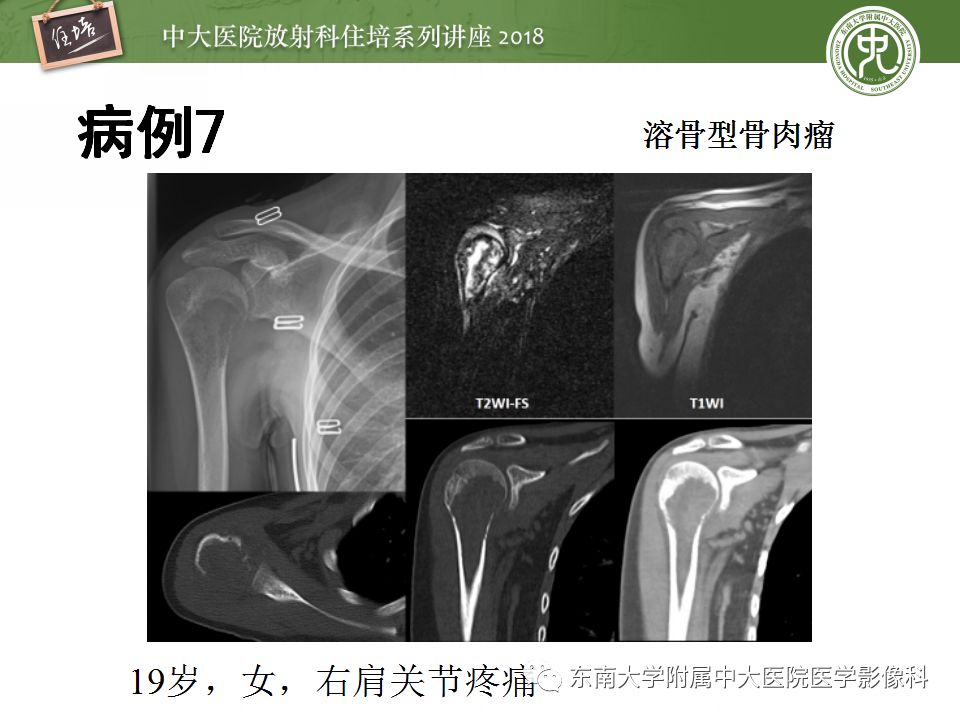 【PPT】骨肿瘤及类肿瘤病变的影像诊断思路
