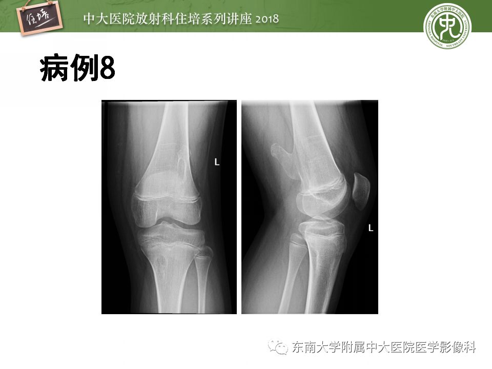 【PPT】骨肿瘤及类肿瘤病变的影像诊断思路