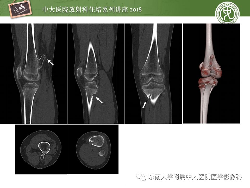 【PPT】骨肿瘤及类肿瘤病变的影像诊断思路
