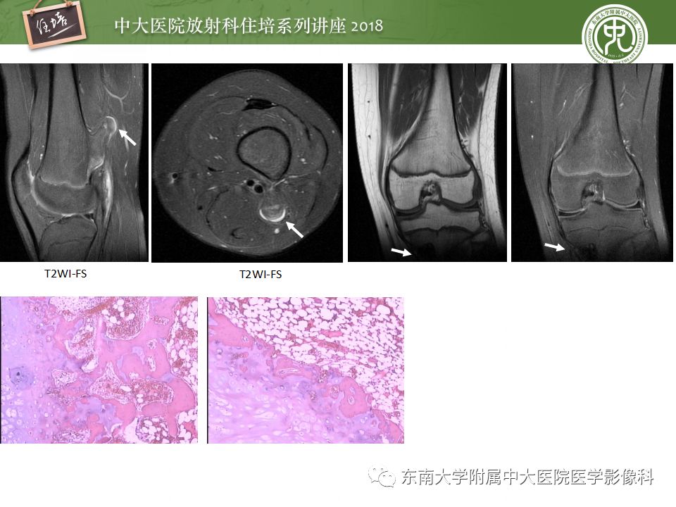 【PPT】骨肿瘤及类肿瘤病变的影像诊断思路