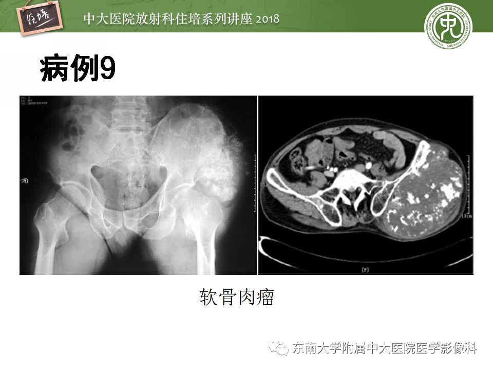 【PPT】骨肿瘤及类肿瘤病变的影像诊断思路
