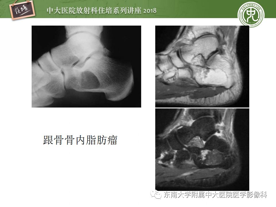 【PPT】骨肿瘤及类肿瘤病变的影像诊断思路