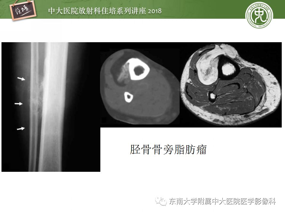 【PPT】骨肿瘤及类肿瘤病变的影像诊断思路