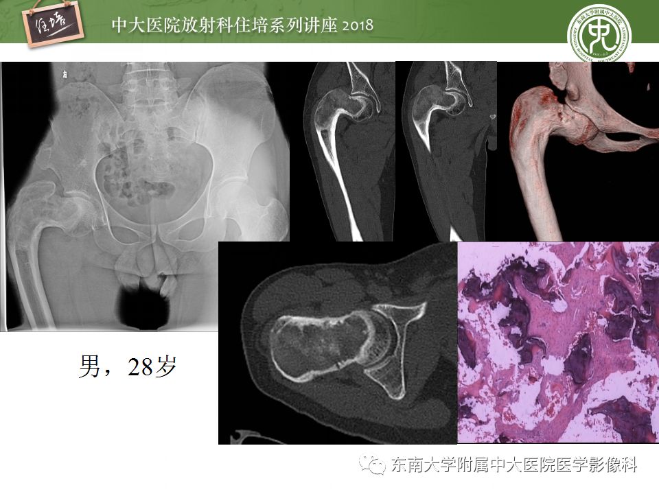 【PPT】骨肿瘤及类肿瘤病变的影像诊断思路