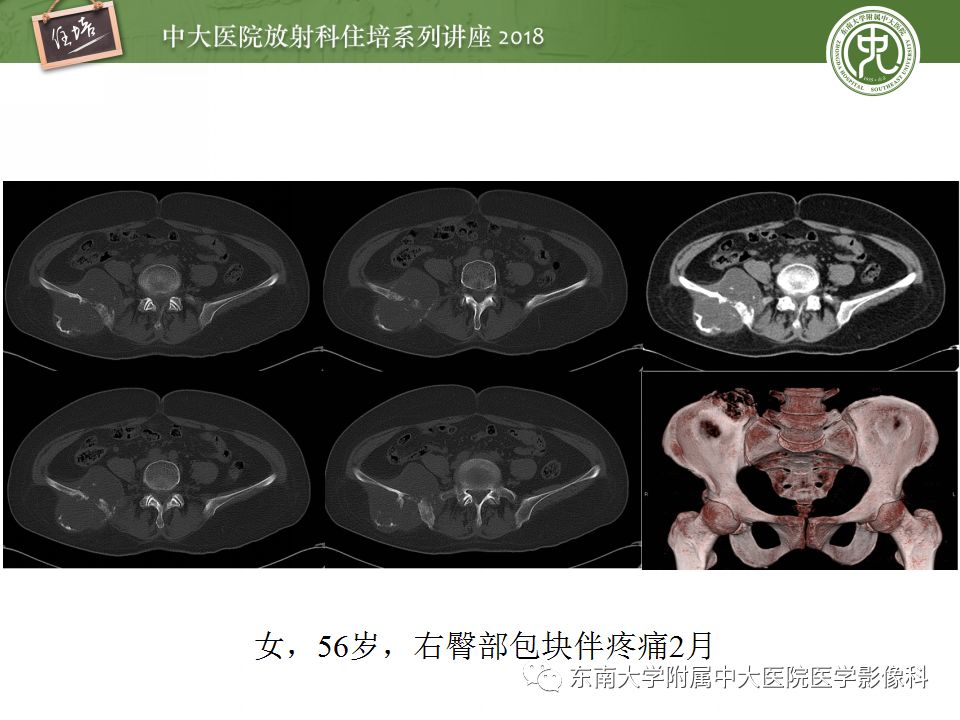【PPT】骨肿瘤及类肿瘤病变的影像诊断思路