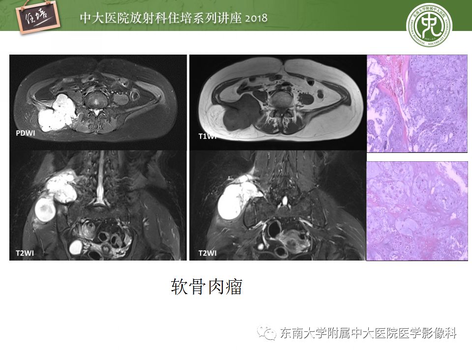 【PPT】骨肿瘤及类肿瘤病变的影像诊断思路