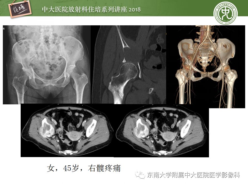 【PPT】骨肿瘤及类肿瘤病变的影像诊断思路