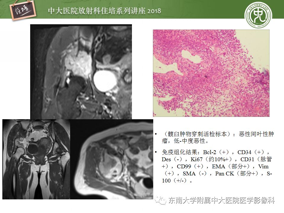 【PPT】骨肿瘤及类肿瘤病变的影像诊断思路