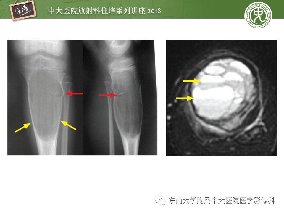 【PPT】骨肿瘤及类肿瘤病变的影像诊断思路