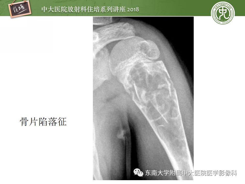 【PPT】骨肿瘤及类肿瘤病变的影像诊断思路