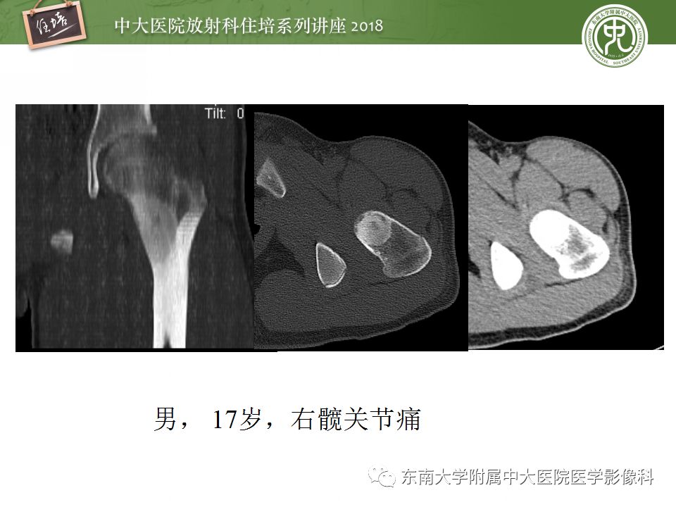 【PPT】骨肿瘤及类肿瘤病变的影像诊断思路