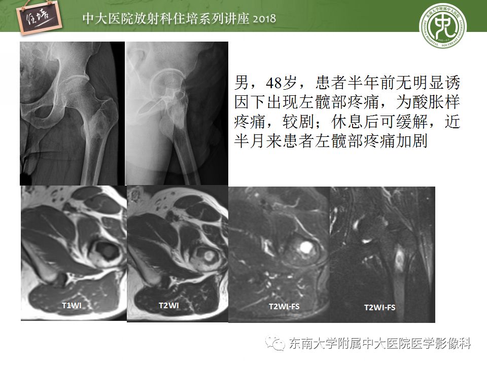【PPT】骨肿瘤及类肿瘤病变的影像诊断思路