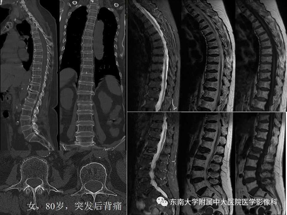 【PPT】骨肿瘤及类肿瘤病变的影像诊断思路