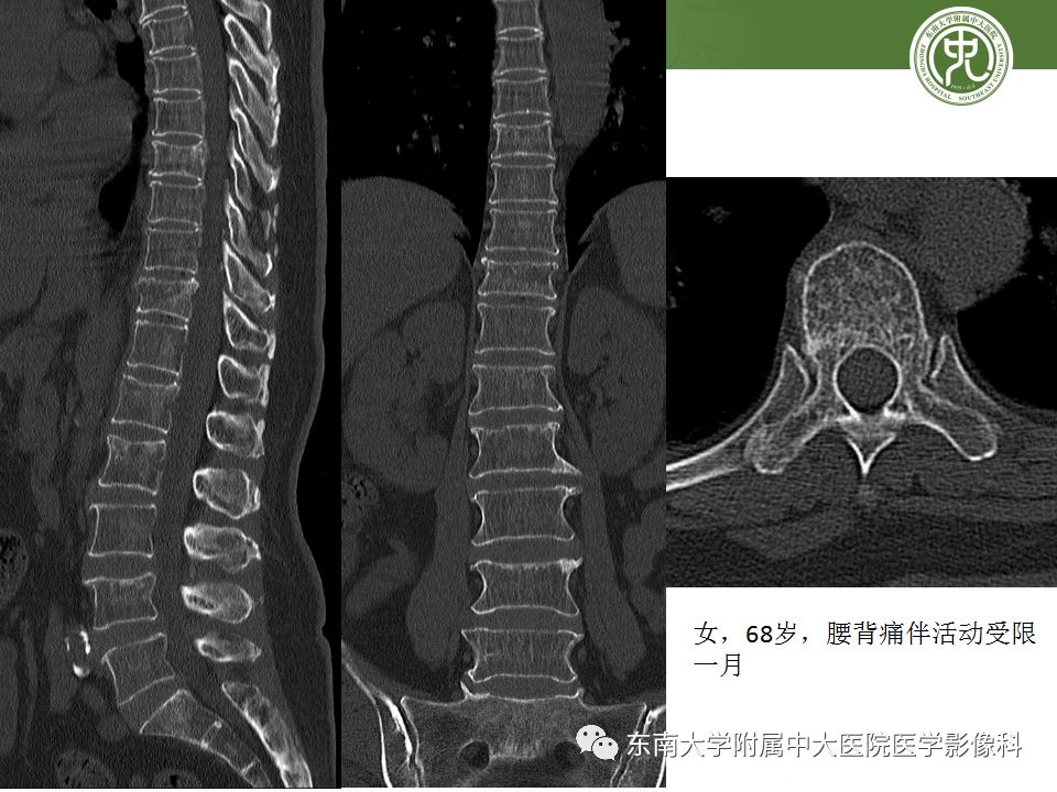 【PPT】骨肿瘤及类肿瘤病变的影像诊断思路