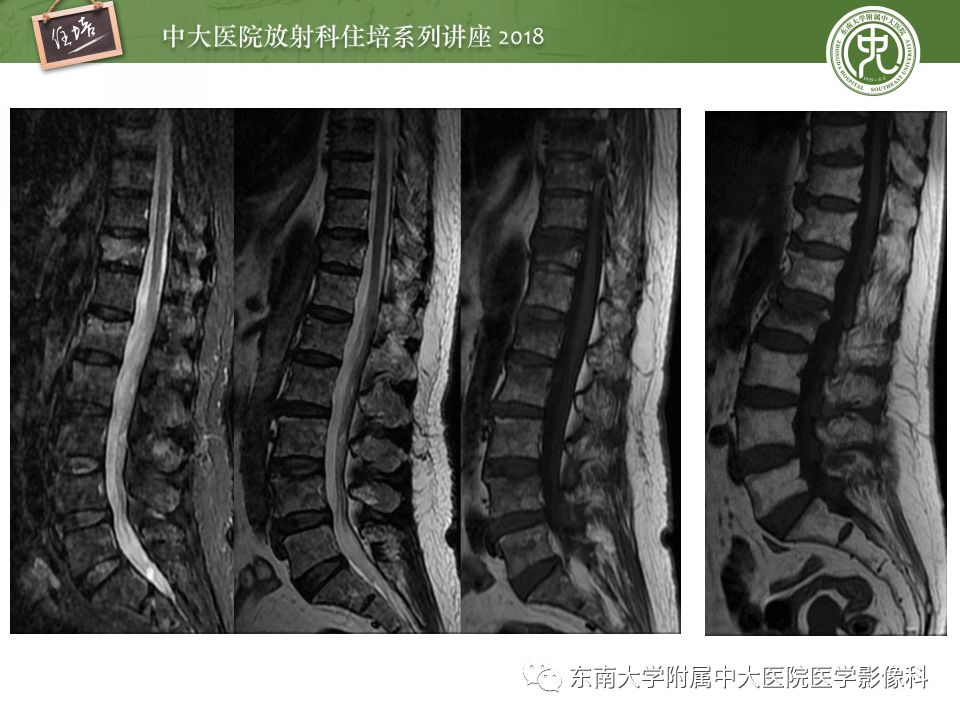【PPT】骨肿瘤及类肿瘤病变的影像诊断思路