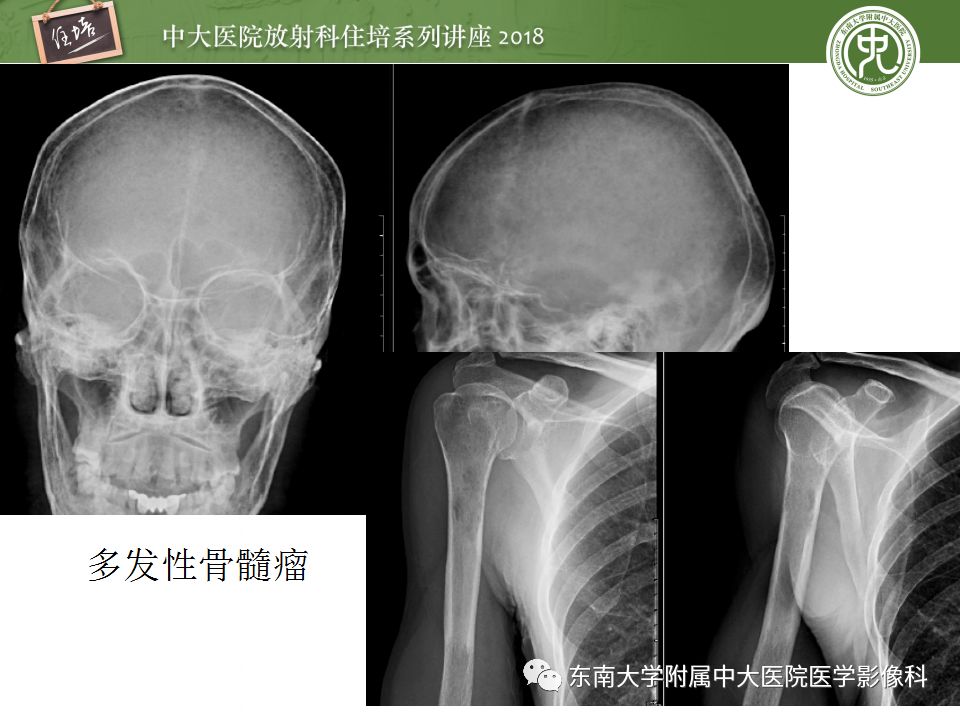 【PPT】骨肿瘤及类肿瘤病变的影像诊断思路