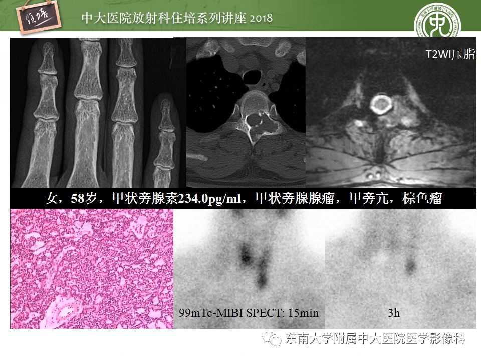【PPT】骨肿瘤及类肿瘤病变的影像诊断思路