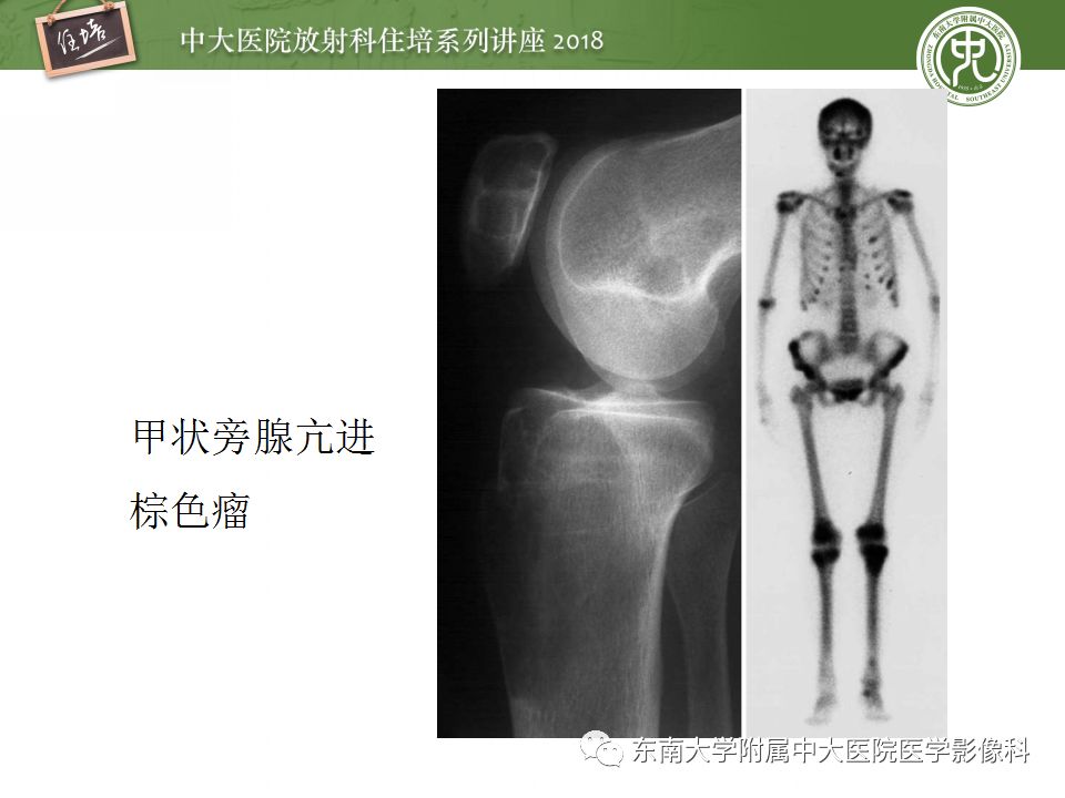【PPT】骨肿瘤及类肿瘤病变的影像诊断思路