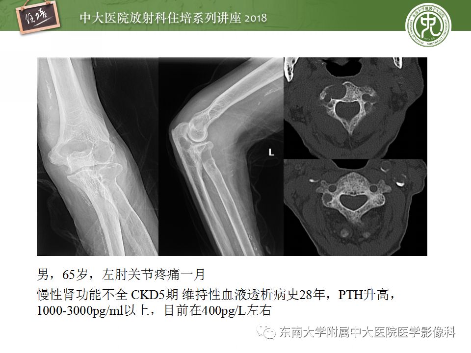 【PPT】骨肿瘤及类肿瘤病变的影像诊断思路