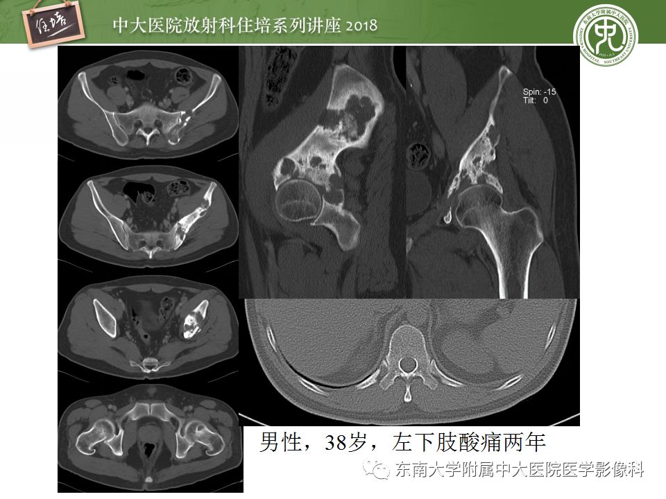 【PPT】骨肿瘤及类肿瘤病变的影像诊断思路
