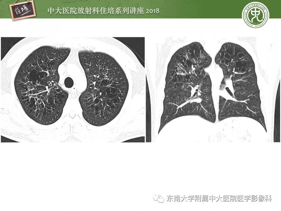 【PPT】骨肿瘤及类肿瘤病变的影像诊断思路