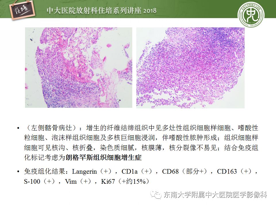 【PPT】骨肿瘤及类肿瘤病变的影像诊断思路