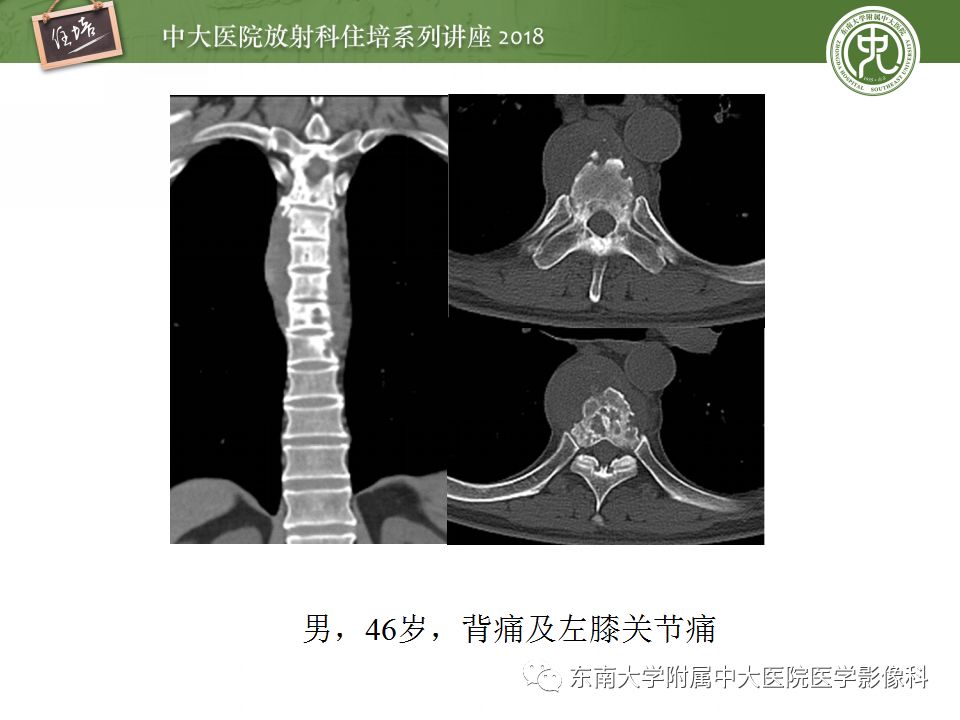 【PPT】骨肿瘤及类肿瘤病变的影像诊断思路