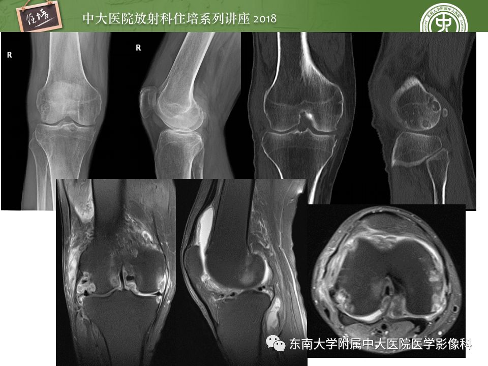 【PPT】骨肿瘤及类肿瘤病变的影像诊断思路