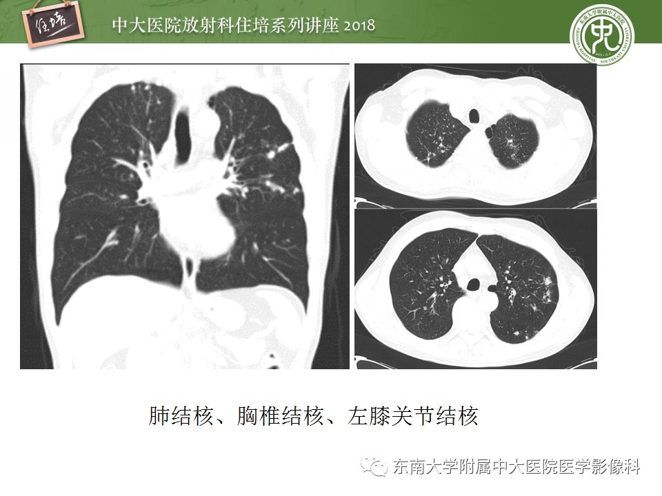 【PPT】骨肿瘤及类肿瘤病变的影像诊断思路