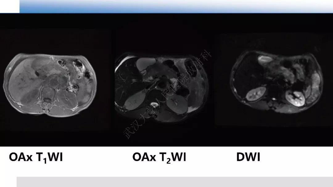 【PPT】胰腺癌与肿块型胰腺炎影像诊断