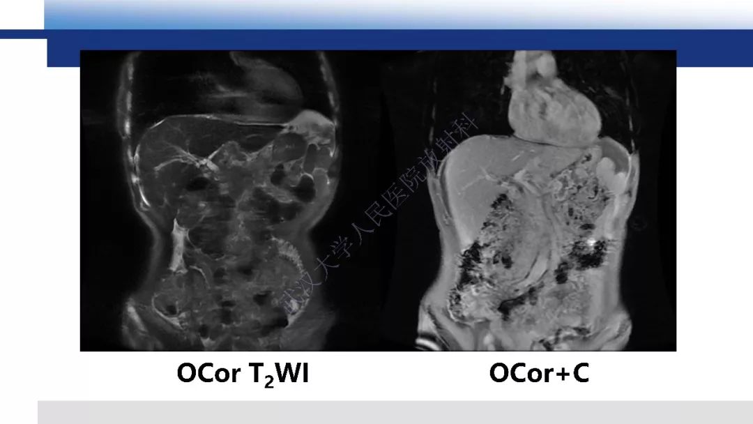 【PPT】胰腺癌与肿块型胰腺炎影像诊断