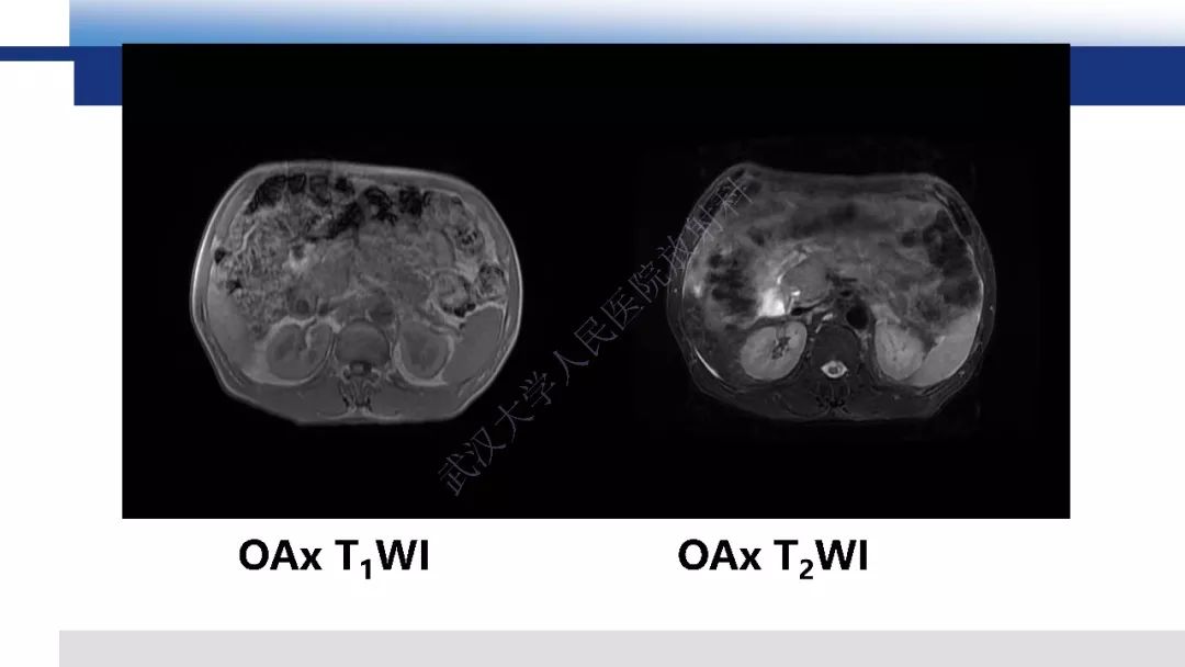 【PPT】胰腺癌与肿块型胰腺炎影像诊断