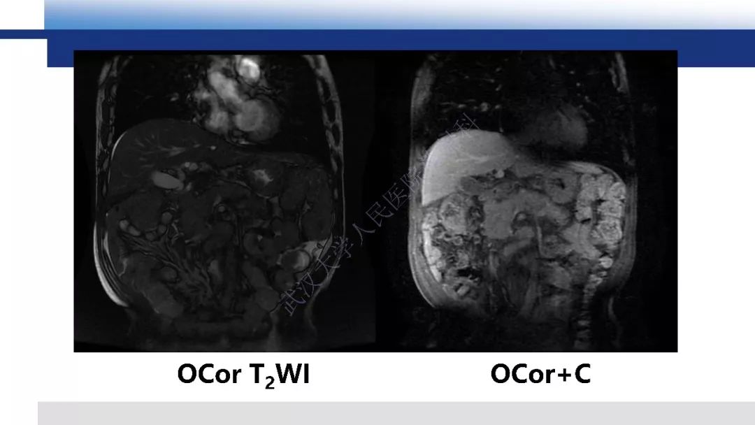 【PPT】胰腺癌与肿块型胰腺炎影像诊断