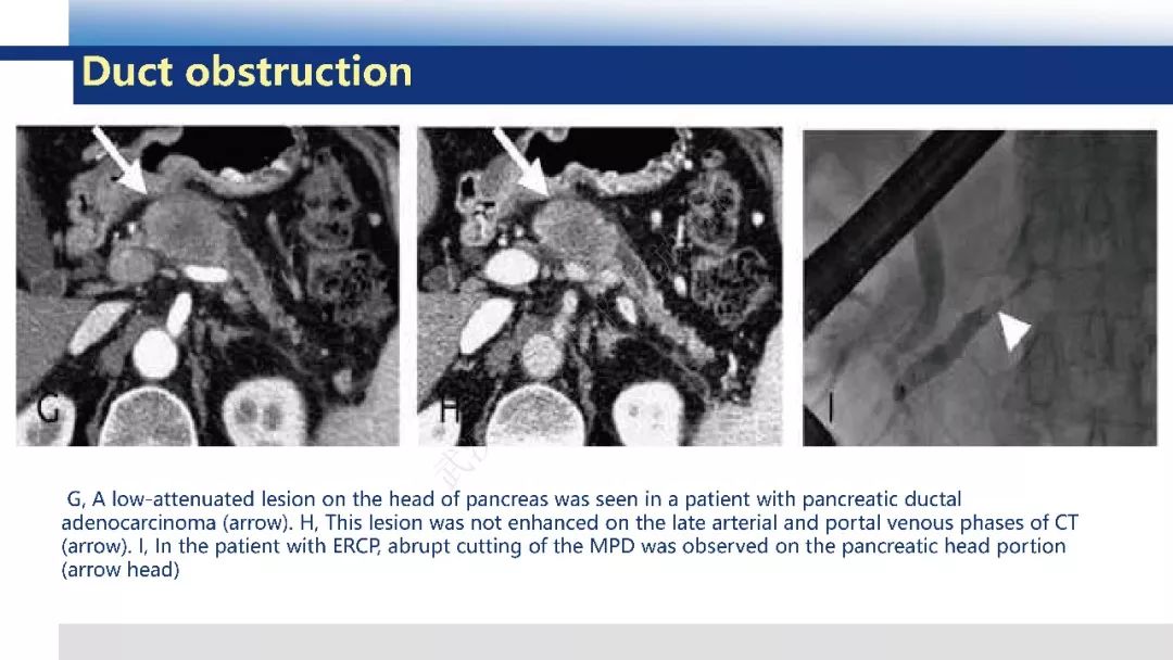 【PPT】胰腺癌与肿块型胰腺炎影像诊断