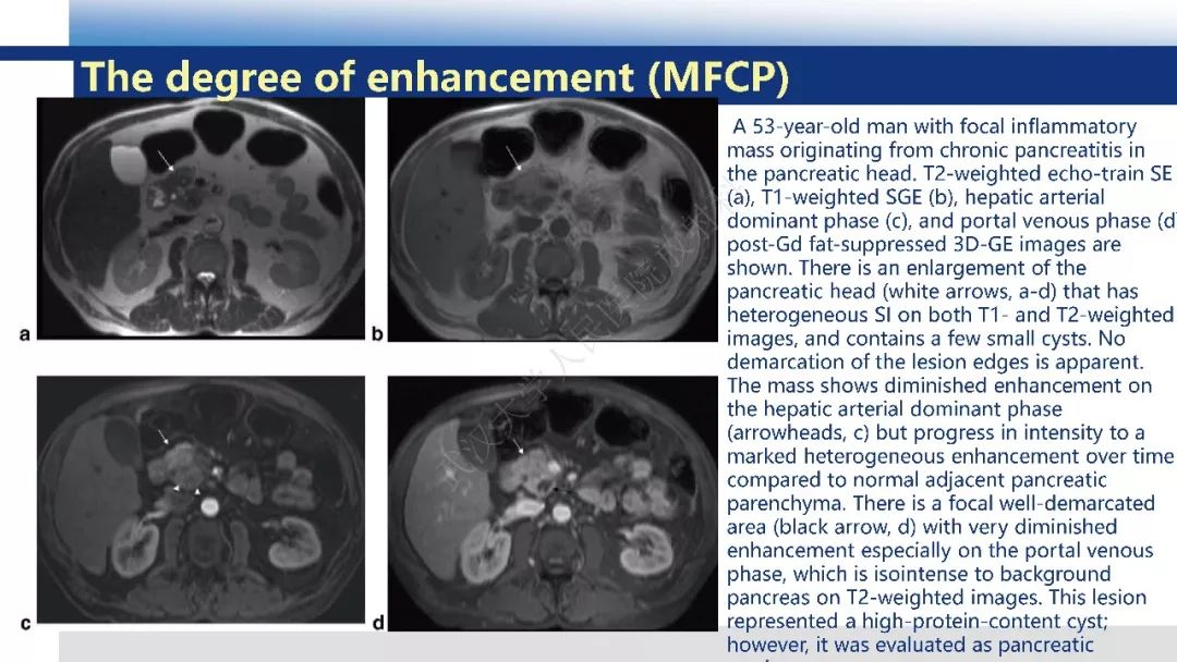 【PPT】胰腺癌与肿块型胰腺炎影像诊断