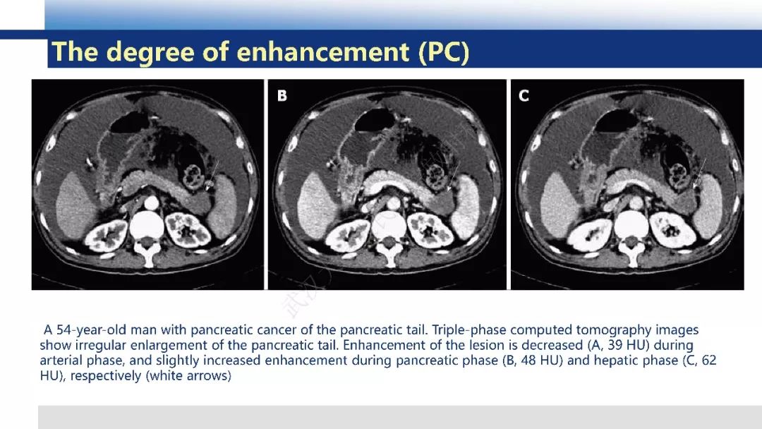 【PPT】胰腺癌与肿块型胰腺炎影像诊断