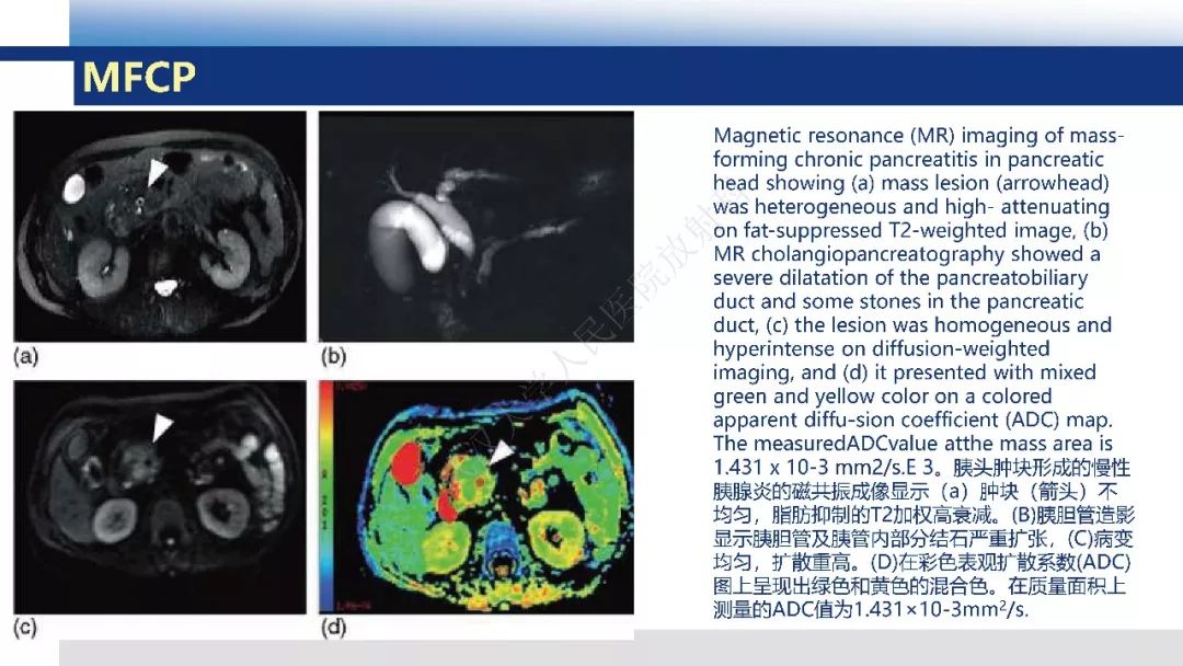 【PPT】胰腺癌与肿块型胰腺炎影像诊断