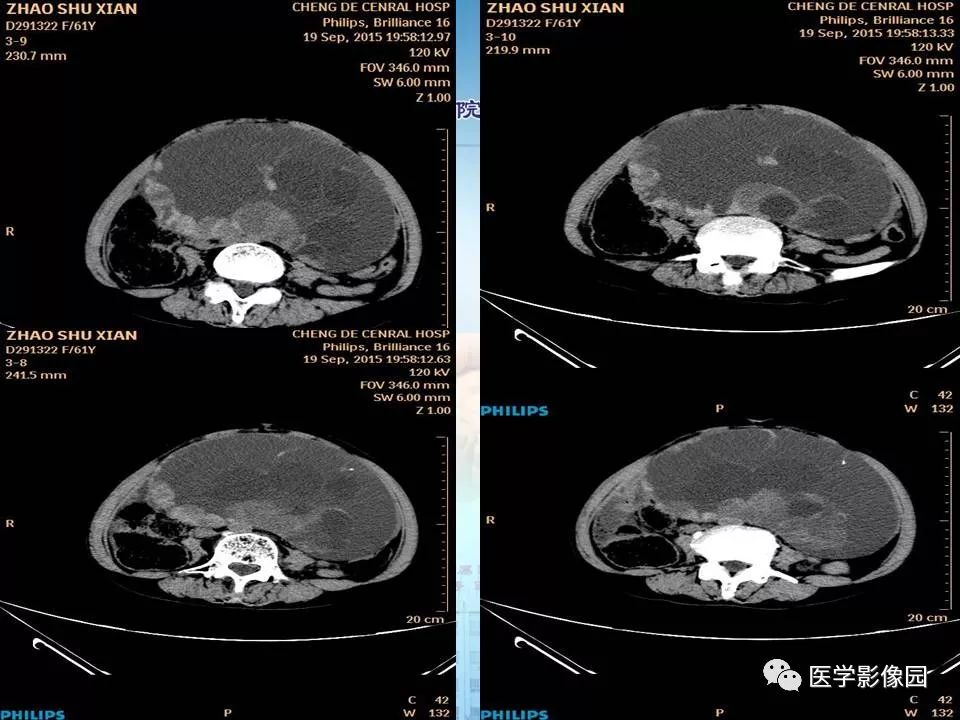 【病例】卵巢粘液性囊腺瘤1例CT影像表现