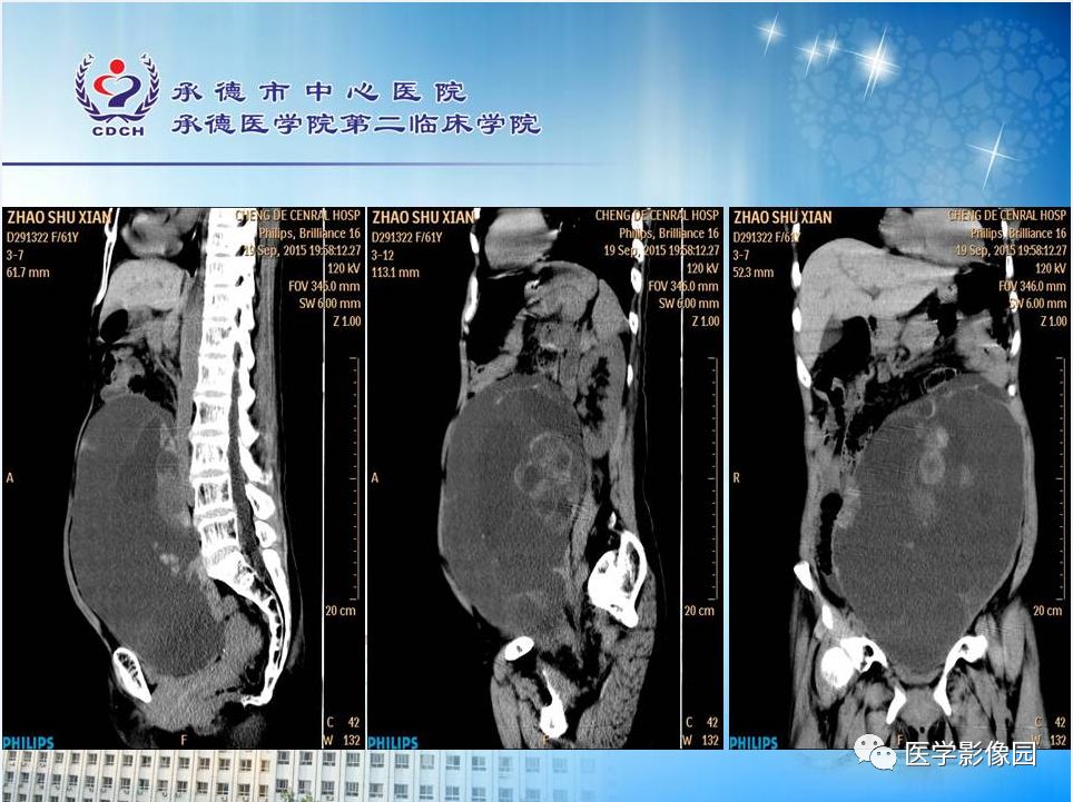 【病例】卵巢粘液性囊腺瘤1例CT影像表现