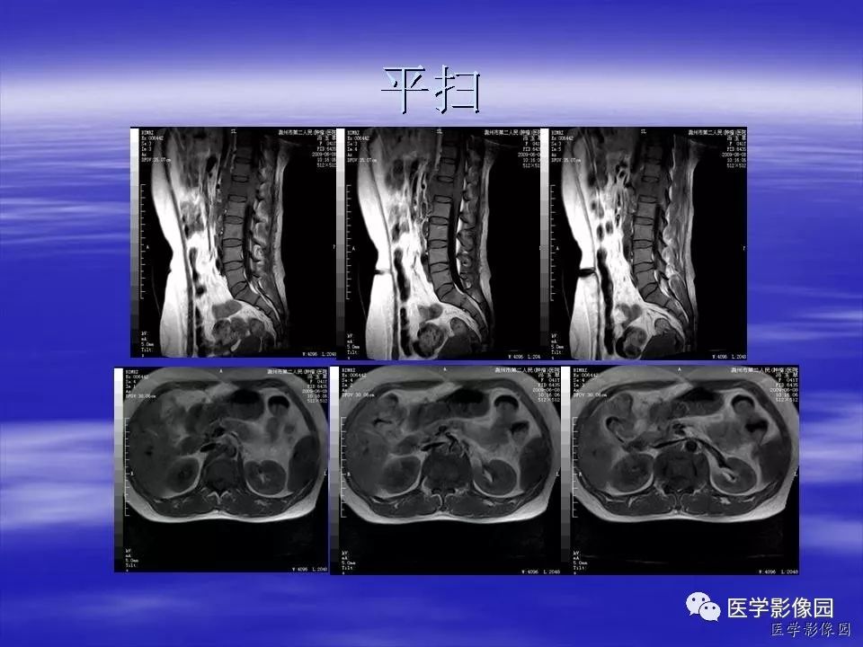 【病例】脊柱淋巴瘤1例MR影像表现 【病例】脊柱淋巴瘤1例MR影像表现