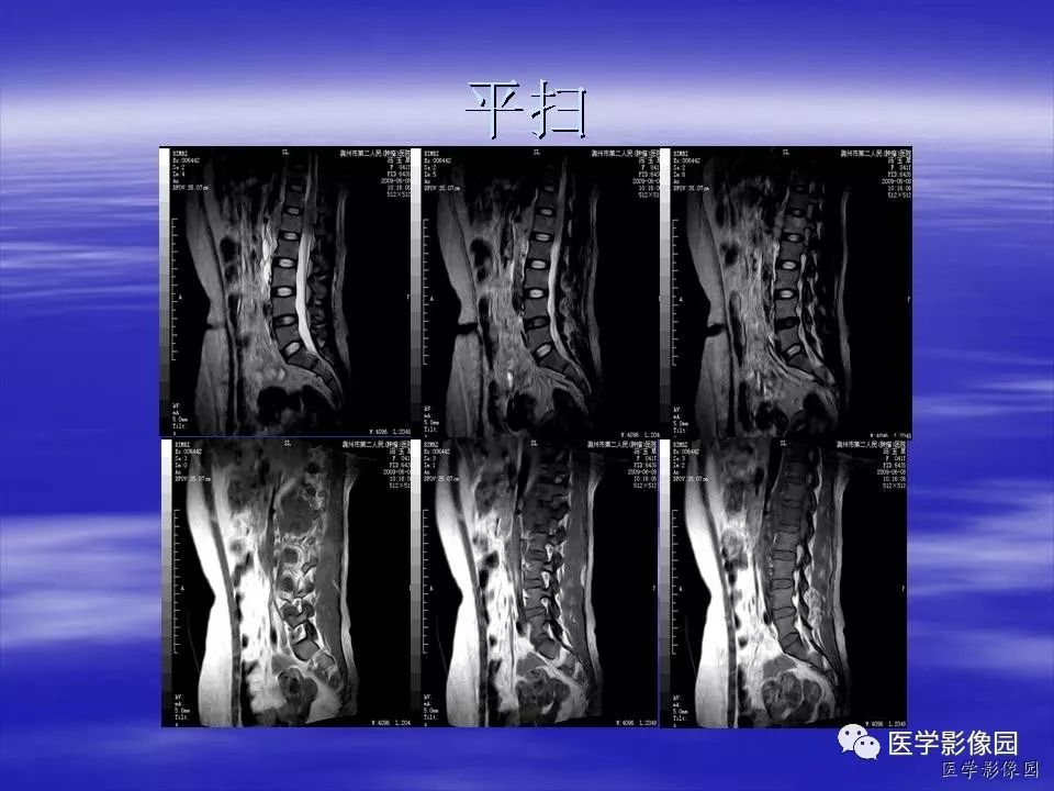 【病例】脊柱淋巴瘤1例MR影像表现