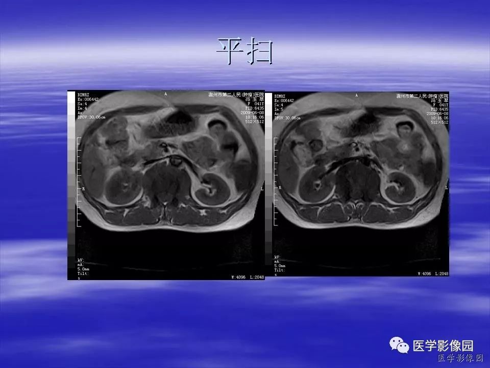 【病例】脊柱淋巴瘤1例MR影像表现 【病例】脊柱淋巴瘤1例MR影像表现