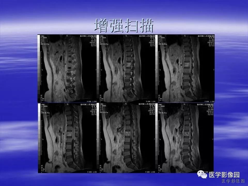 【病例】脊柱淋巴瘤1例MR影像表现 【病例】脊柱淋巴瘤1例MR影像表现